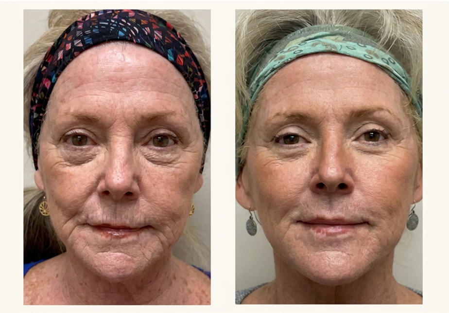Xerf Treatment Before and After Results