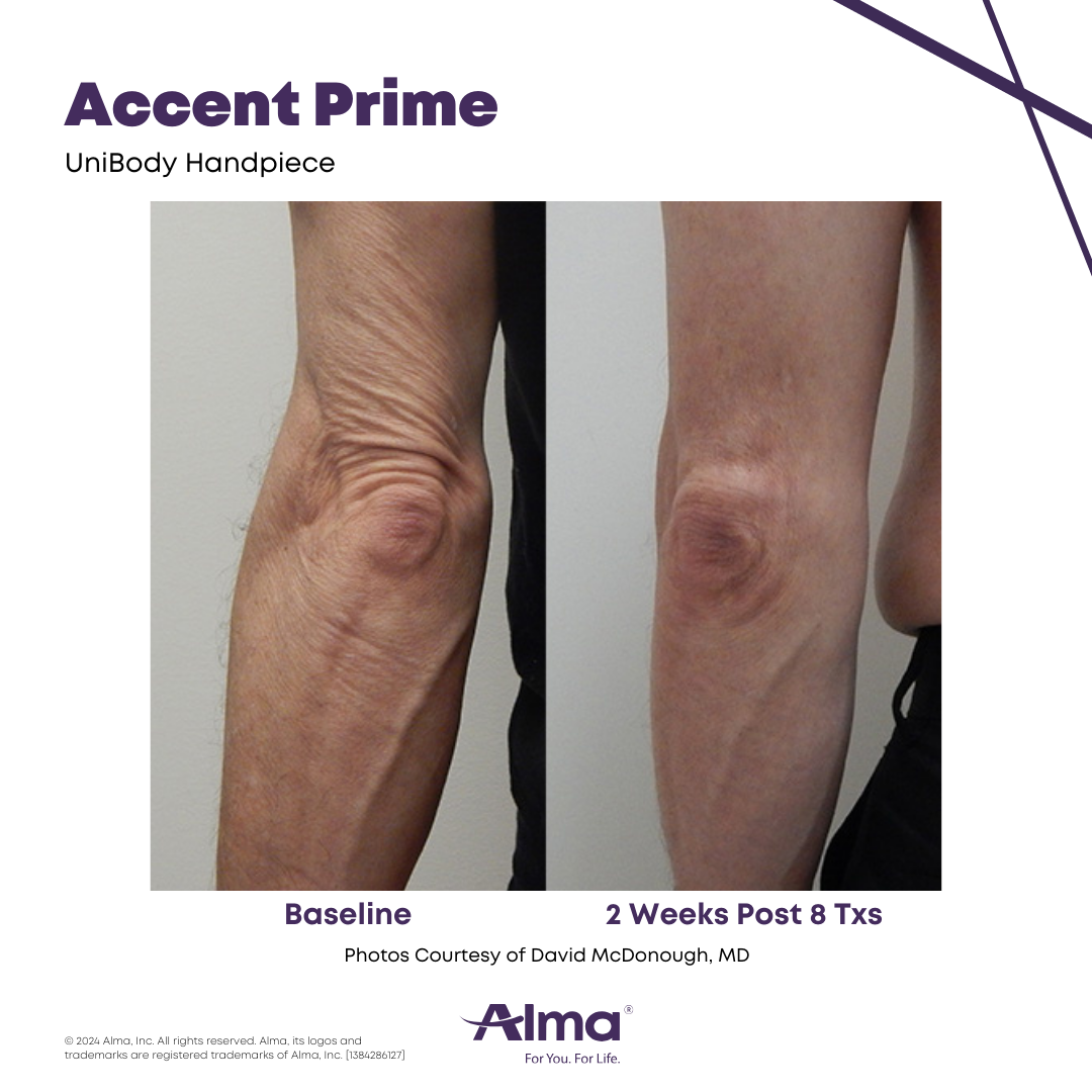 Accent Prime Arms Accent Prime body contouring radiofrequency treatment targeting fat reduction and skin tightening on the arms.