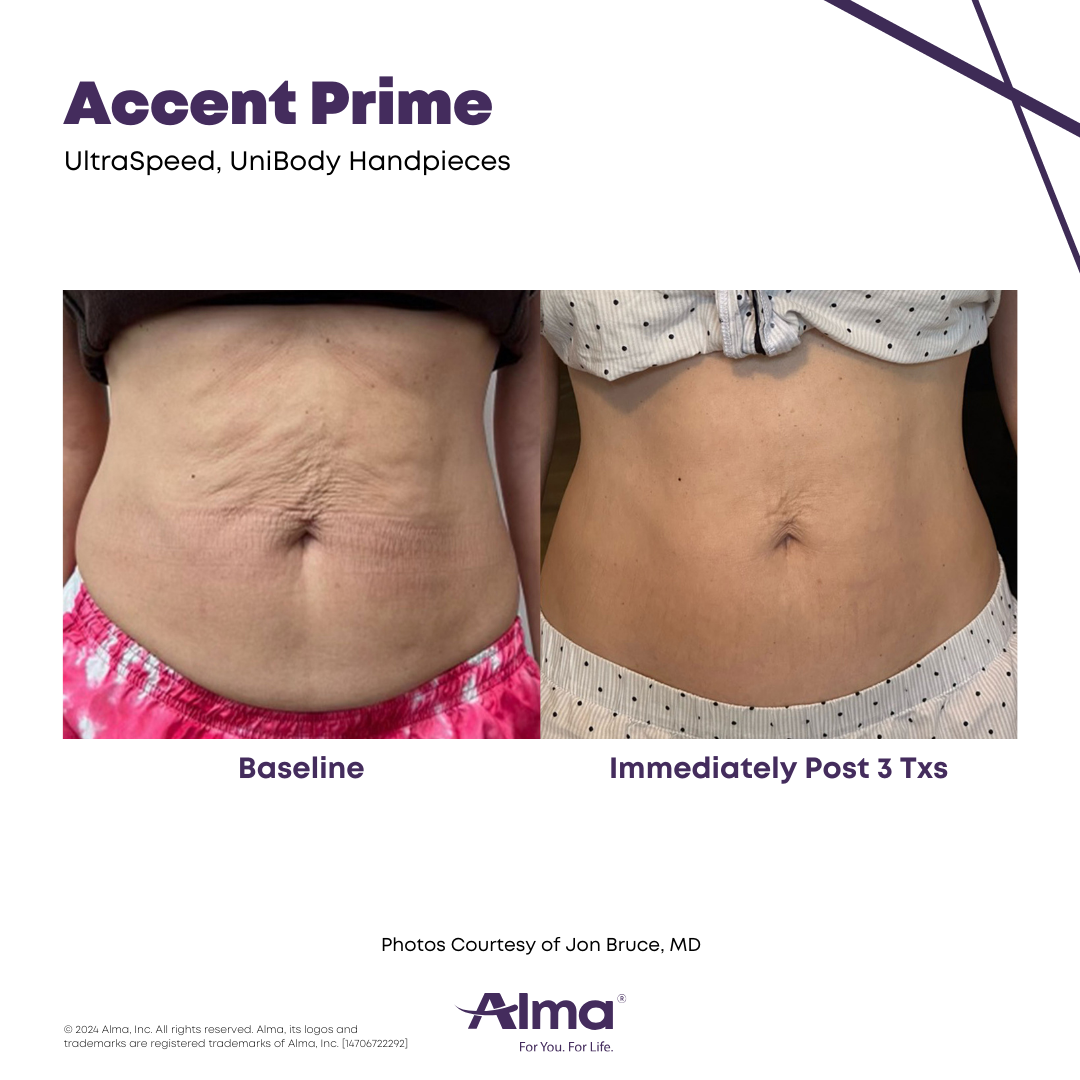 Accent Prime The Accent Prime body contouring and skin tightening workstation device in a treatment room.