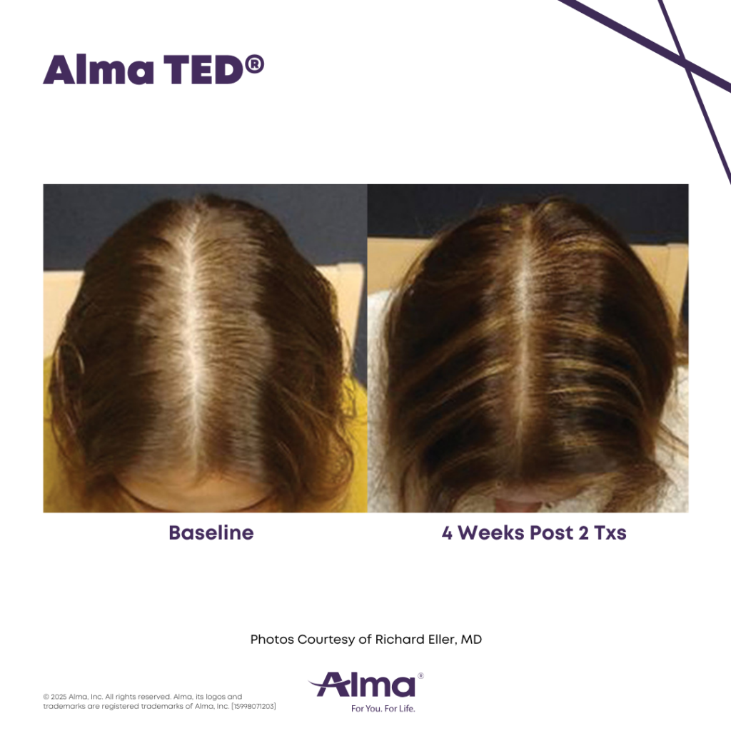 The Alma TED non-invasive ultrasound hair restoration system device.