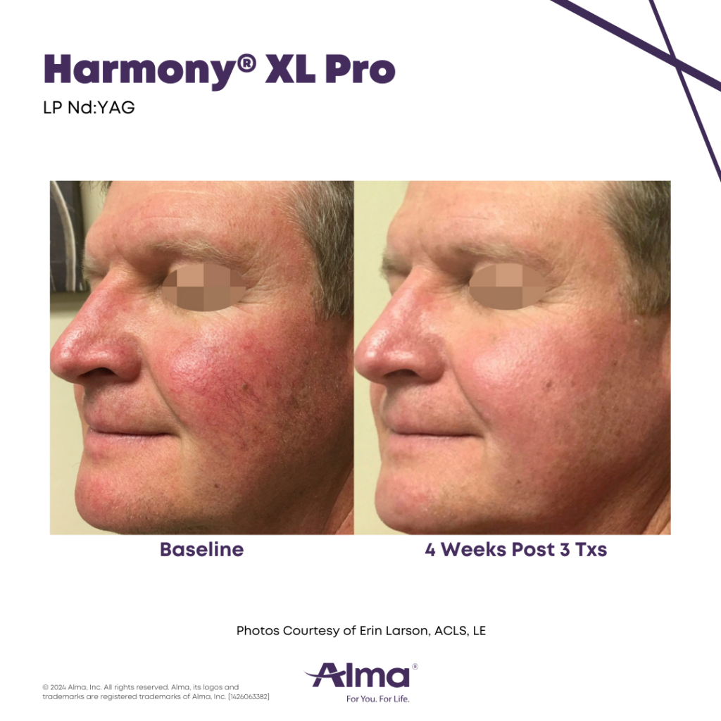 Harmony Long-Pulsed Nd:YAG laser handpiece configured for laser vein removal treatments.