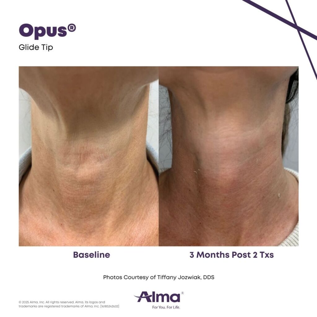 Opus Laser Picture The Alma Opus Plasma radiofrequency and plasma skin resurfacing workstation device.