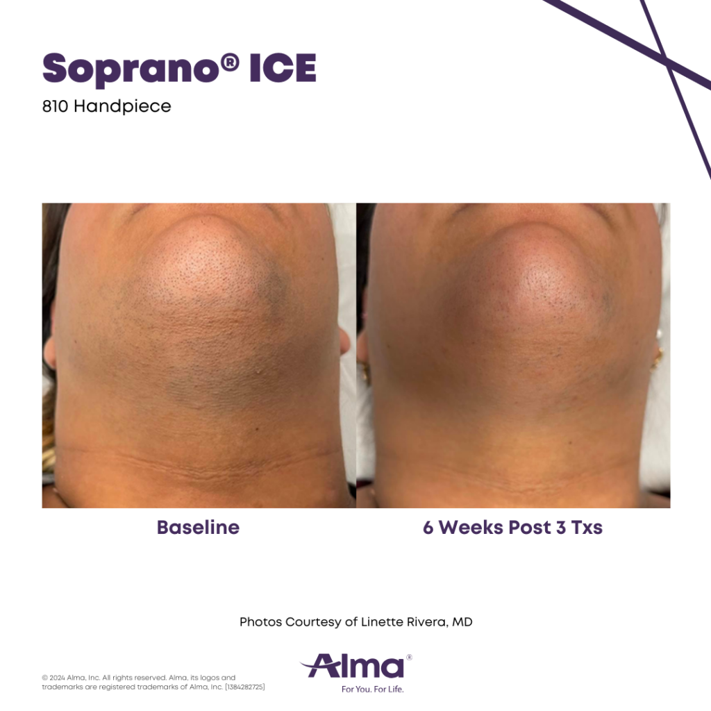 Soprano_Platinum_BA_L.Rivera_Q1-22_1384282725_canva Before and after photo comparison showing hair clearance results after Soprano ICE Platinum laser hair reduction treatments.